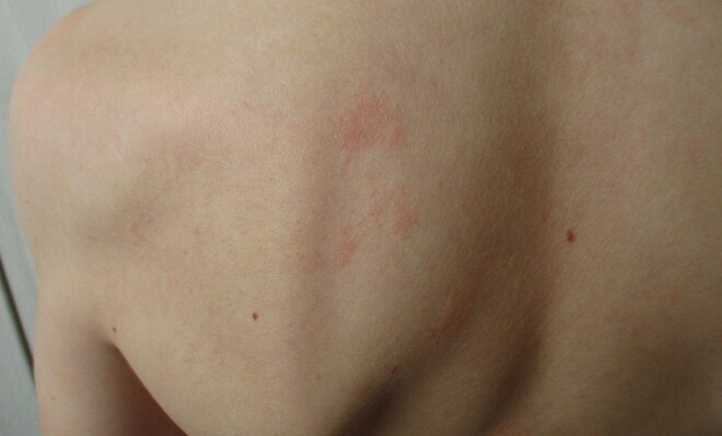 Es importante identificar correctamente los alérgenos responsables para poder manejar eficazmente la condición.